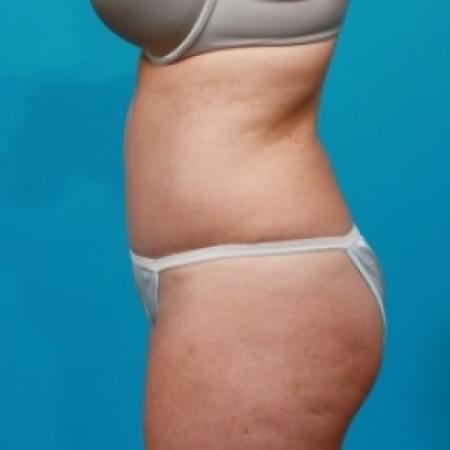 After image 3 Case #78856 - Abdominoplasty & Flank Liposuction
