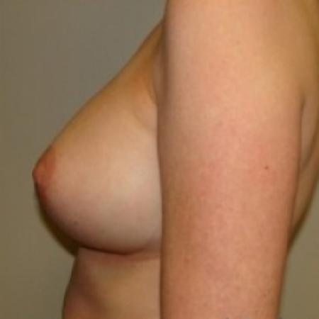 After image 3 Case #79366 - Breast Augmentation