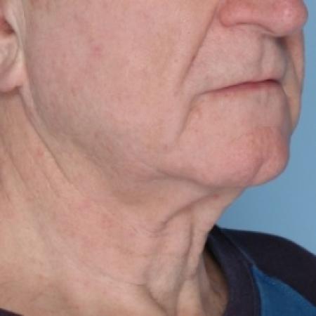 After image 2 Case #80626 - Ulthera