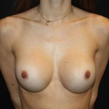 After image 1 Case #85306 - Breast Augmentation - 27 year old female