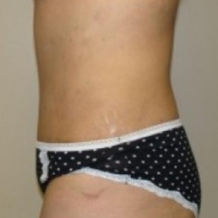 After image 3 Case #79481 - Tummy Tuck