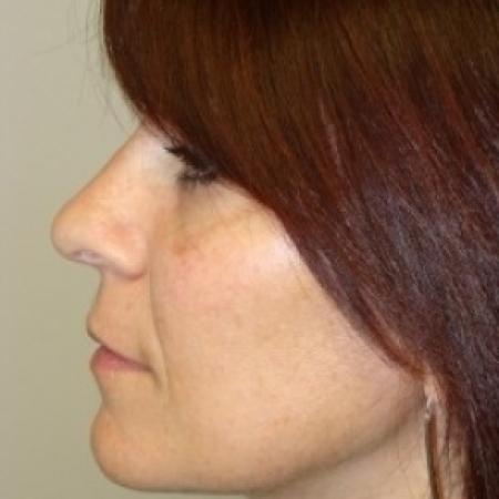 After image 5 Case #79556 - Rhinoplasty