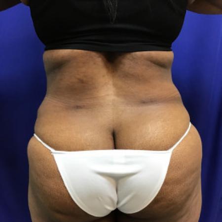 After image 4 Case #88281 - Tummy Tuck and Liposuction