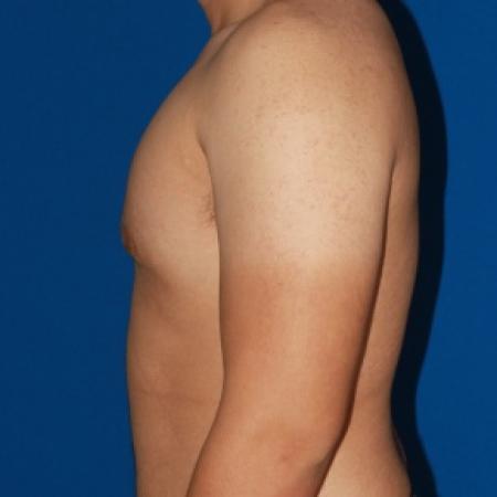 After image 3 Case #79991 - Gynecomastia male breast reduction