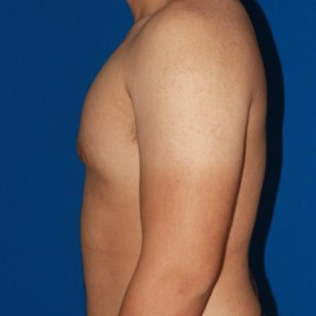 After image 3 Case #79991 - Gynecomastia male breast reduction
