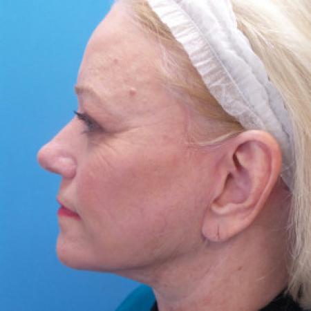 After image 3 Case #88146 - 66 year old - Facelift/Upper & Lower Blepharoplasty/Skin Resurfacing - 4 months post-op