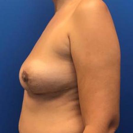 After image 3 Case #88466 - Breast implant removal on a 38 year old female 