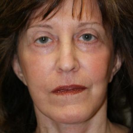 After image 1 Case #81916 - Facelift