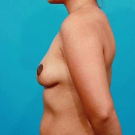 After image 3 Case #80766 - Asymmetric Breast Lift