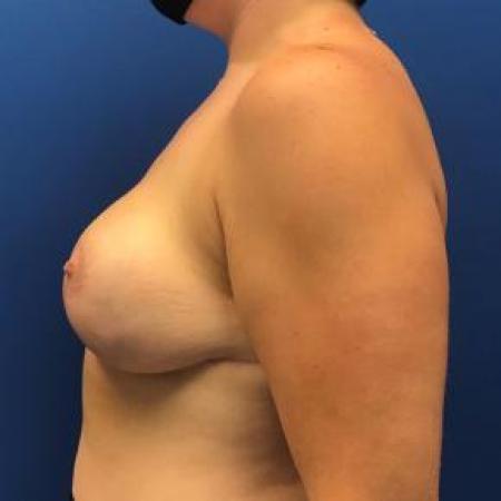 After image 2 Case #88431 - Breast lift on a 32 year old female