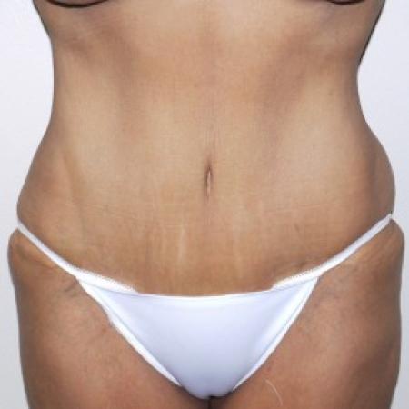 After image 1 Case #82356 - 57 year old after tummy tuck