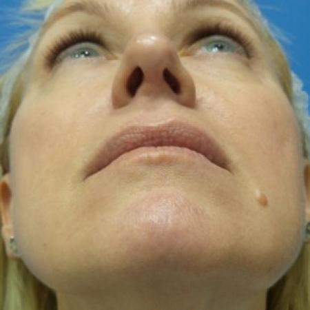 After image 4 Case #87096 - 49 year old  -  Rhinoplasty/Septoplasty/Turbinectomy  -  3 months post-op