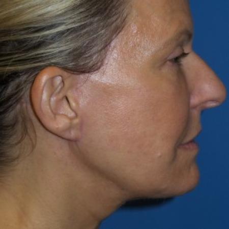 After image 3 Case #86591 - Facelift/Upper Blepharoplasty     3 months post-op