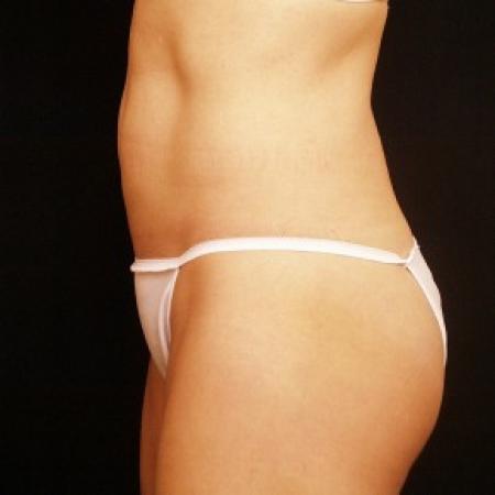 After image 2 Case #81751 - Liposuction