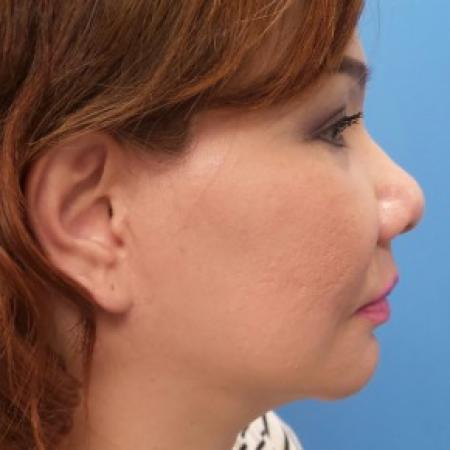 After image 3 Case #86586 - Facelift