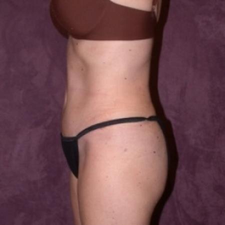 After image 3 Case #79891 - Tummy tuck with liposuction of hips
