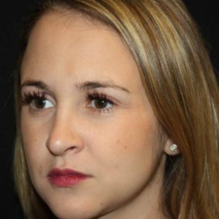 After image 2 Case #84211 - Rhinoplasty - 24 year old female.