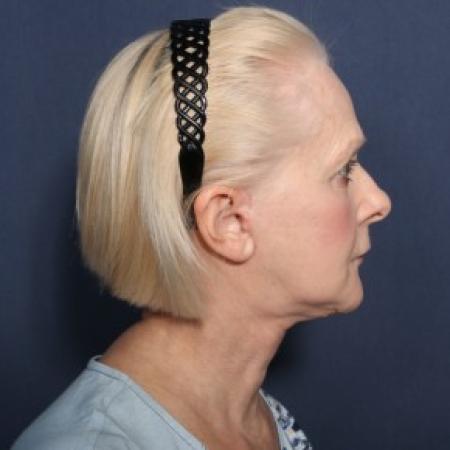 After image 2 Case #84356 - 67 Years Old Female