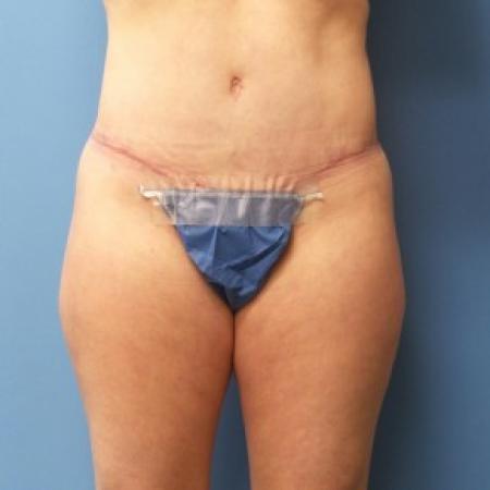 After image 1 Case #86701 - Abdominoplasty - 3 months post-op
