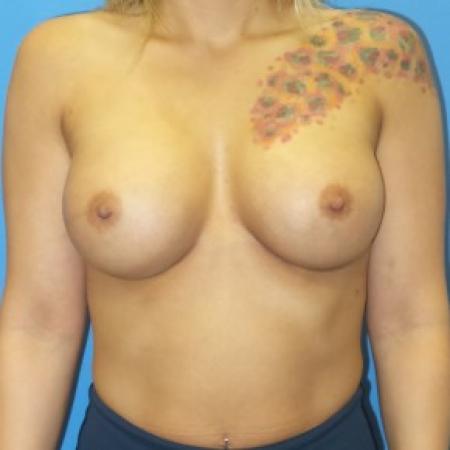 After image 1 Case #86646 - Submuscular Breast Augmentation 420cc Shaped - Medium Height Silicone Gel Implants