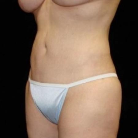 After image 4 Case #80226 - Circumfrential Abdominoplasty with Liposuction of Abdomen, Waist, and Flanks