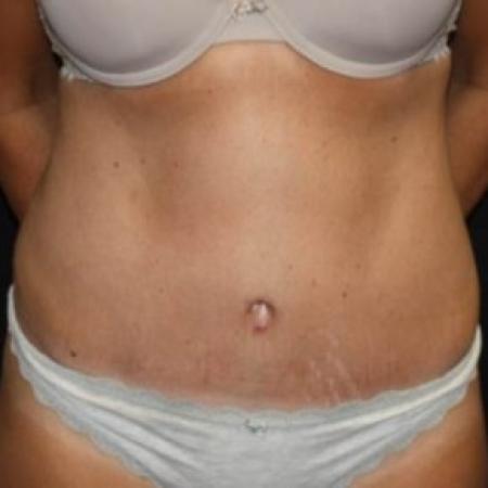 After image 1 Case #84291 - Abdominoplasty - 39 year old female