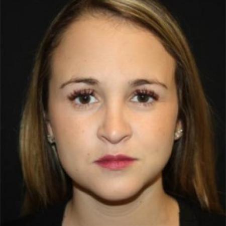 After image 1 Case #84211 - Rhinoplasty - 24 year old female.