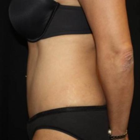 After image 3 Case #85591 - Abdominoplasty - 44 year old female