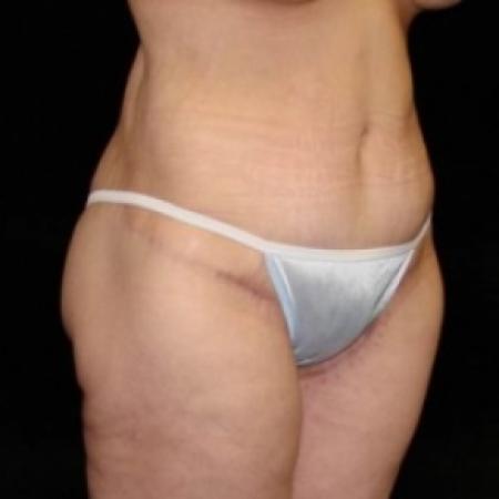 After Case #80256 - Lower Body Lift / Inner Thigh Lift