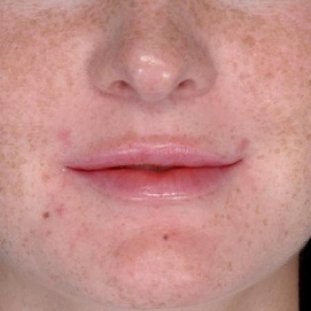 After image 1 Case #79291 - Injectables