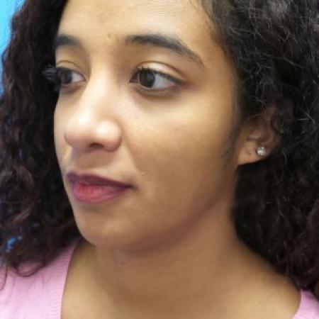 After image 2 Case #86471 - Rhinoplasty/Septoplasty/Turbinectomy - 1 year post-op