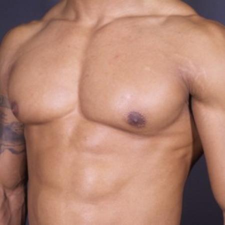 After image 2 Case #84876 - Excision of Left Gynecomastia
