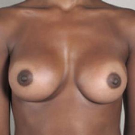 After image 1 Case #80636 - Breast Augmentation New Jersey