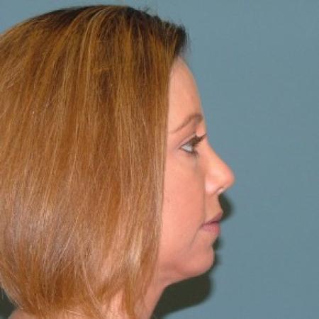 After image 3 Case #86736 - Rhinoplasty+ chin augmentation with silicone implant