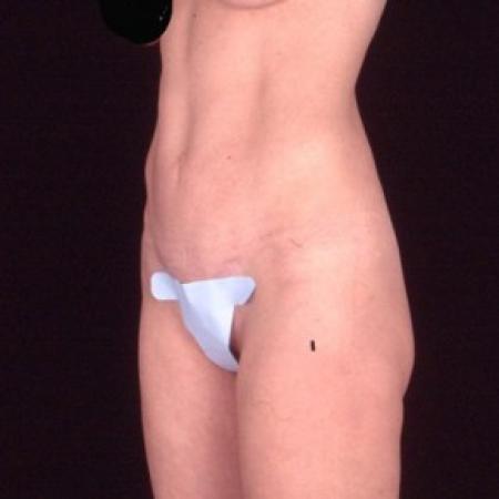 After image 2 Case #81566 - Tummy Tuck