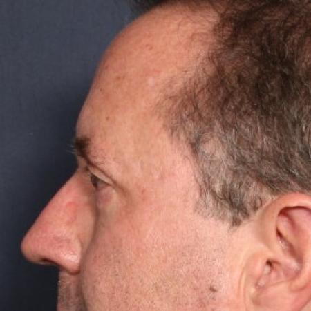 After image 2 Case #84941 - 58 Years Old Male