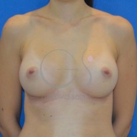 After image 1 Case #87636 - Anatomical breast augmentation