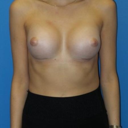 After image 1 Case #86421 - Submuscular Breast Augmentation 295cc High Cohesive Silicone Gel Implants