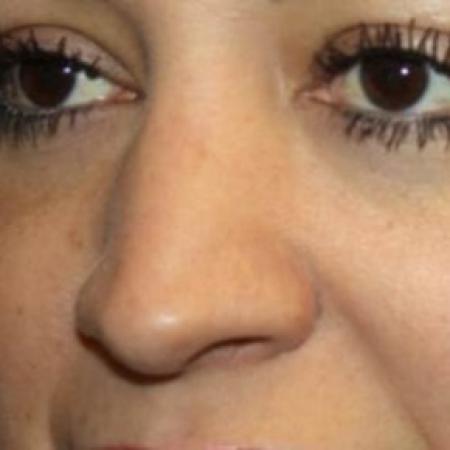 After image 2 Case #85136 - Rhinoplasty - 43 year old female