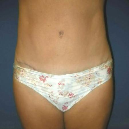 After image 1 Case #82821 - Tummy Tuck and Liposuction of Hips