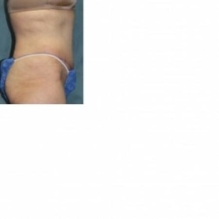 After image 2 Case #81071 - Abdominoplasty