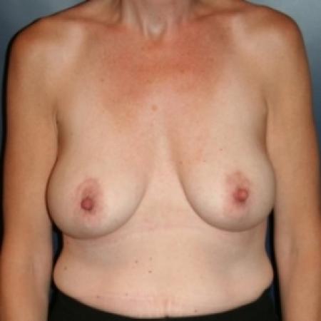 After image 1 Case #80391 - Natural Proportional Breast Augmentation