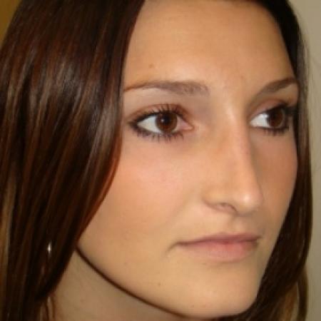 After image 4 Case #79961 - Open Rhinoplasty