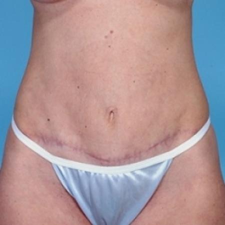 After image 1 Case #79161 - Tummy Tuck