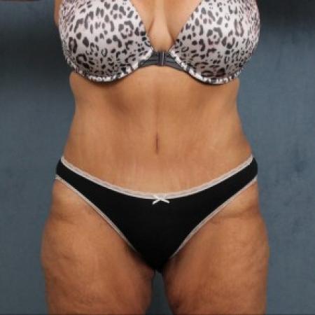 After image 1 Case #82551 - extended abdominoplasty (tummy tuck) after massive weight loss