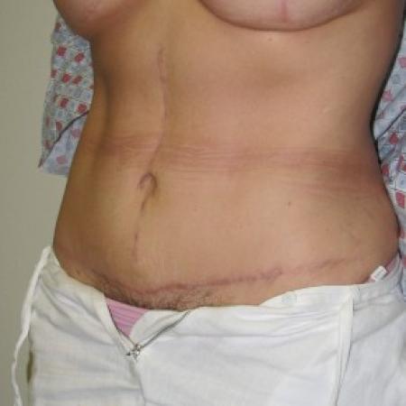 After image 2 Case #85806 - Massive weight loss patient with Fleur-de-Lis abdominoplasty