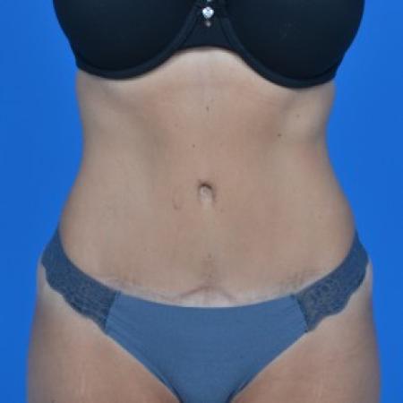 After image 1 Case #87841 - Tummy Tuck