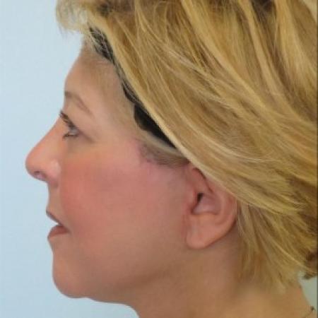 After image 2 Case #82696 - 53 Year Old Woman's Facial Rejuvenation