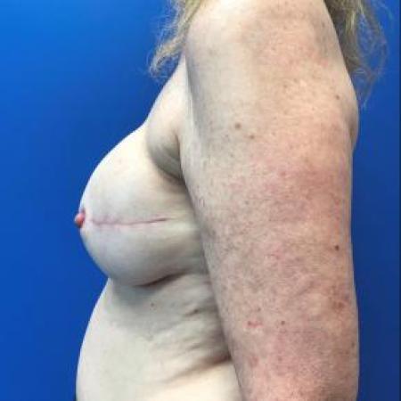 After image 2 Case #88211 - Breast Reconstruction on a 63 year old female patient