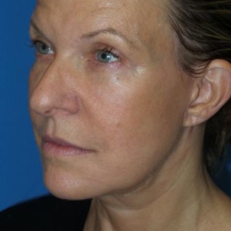 After image 2 Case #86591 - Facelift/Upper Blepharoplasty     3 months post-op